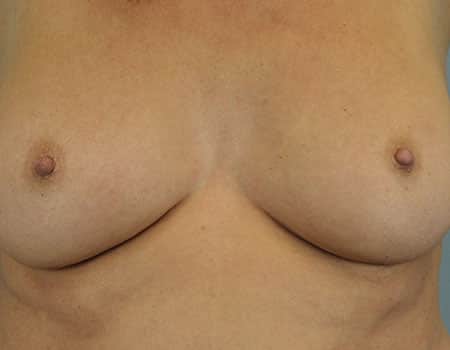 Female patient after nipple procedure performed by Dr. Paul Vanek