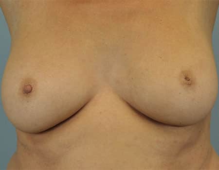 Female patient before nipple procedure performed by Dr. Paul Vanek