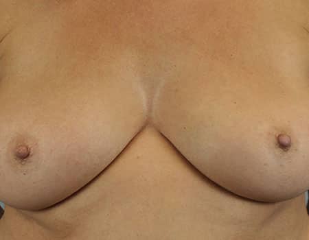 Female patient after nipple procedure performed by Dr. Paul Vanek