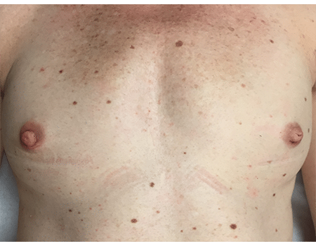 Patient after nipple procedure performed by Dr. Paul Vanek
