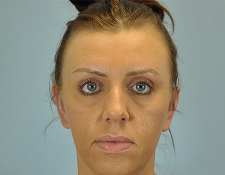 Female patient after Ear Surgery (otoplasty) procedure performed by Dr. Paul Vanek