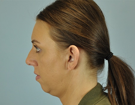 Female patient after Ear Surgery (otoplasty) procedure performed by Dr. Paul Vanek