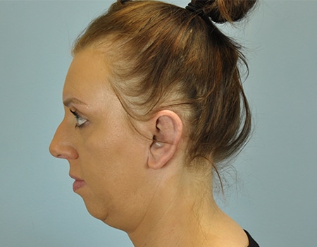 Female patient before Ear Surgery (otoplasty) procedure performed by Dr. Paul Vanek