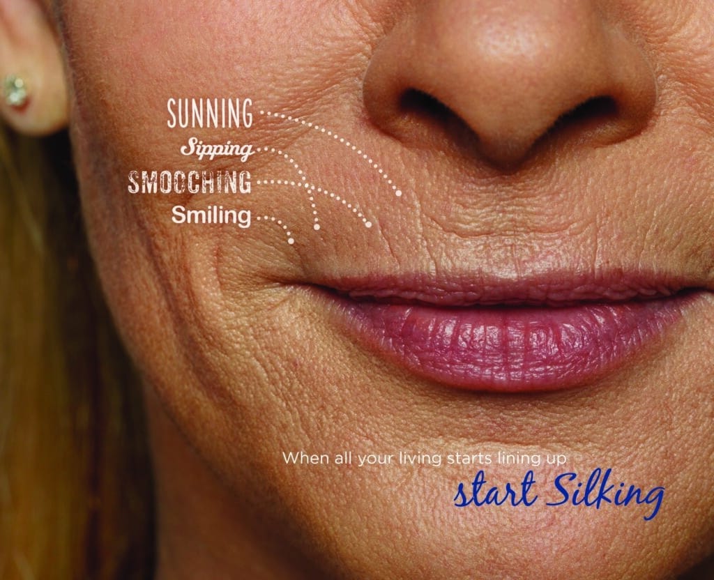 Close up of a woman's mouth displaying sun damage and other wrinkles for Restylane blog photo