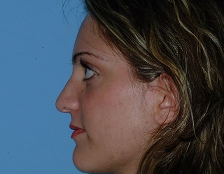 Female patient after Rhinoplasty performed by Dr. Paul Vanek