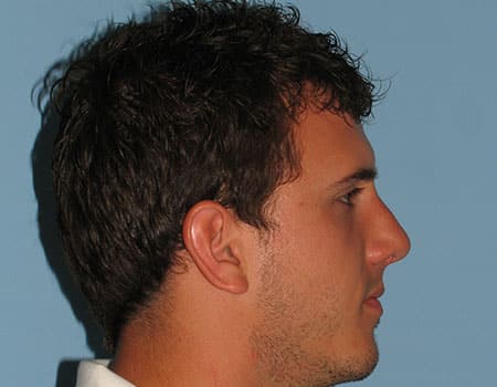 Male patient after Rhinoplasty performed by Dr. Paul Vanek