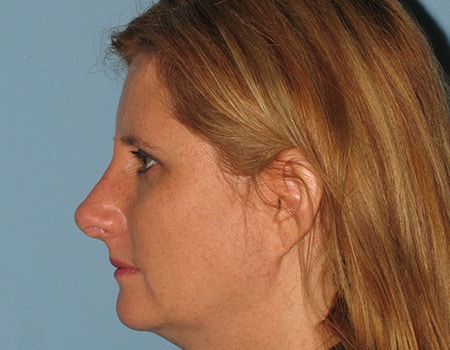 Female patient after Rhinoplasty procedure performed by Dr. Paul Vanek