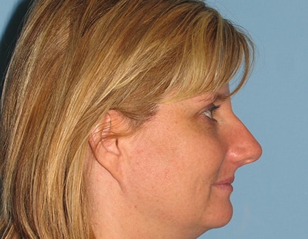 Female patient before Rhinoplasty procedure performed by Dr. Paul Vanek
