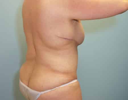 Patient after Weight Loss procedure performed by Dr. Paul Vanek
