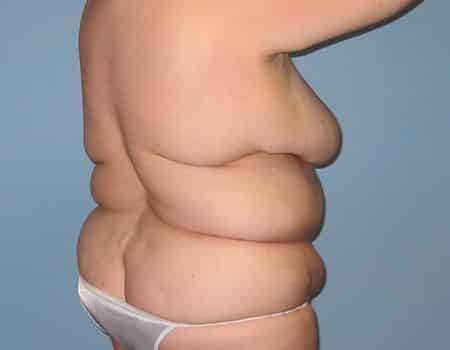 Patient before Weight Loss procedure performed by Dr. Paul Vanek