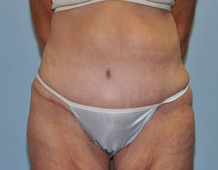 Patient after weight loss procedure performed by Dr. Paul Vanek