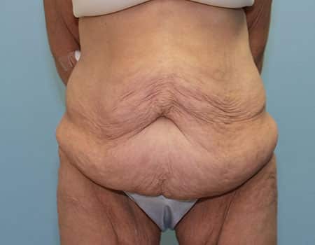 Patient before weight loss procedure performed by Dr. Paul Vanek