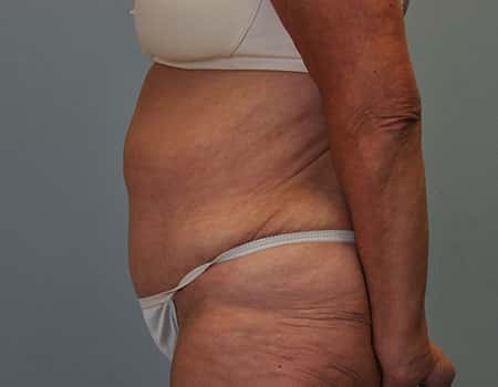 Patient after weight loss procedure performed by Dr. Paul Vanek