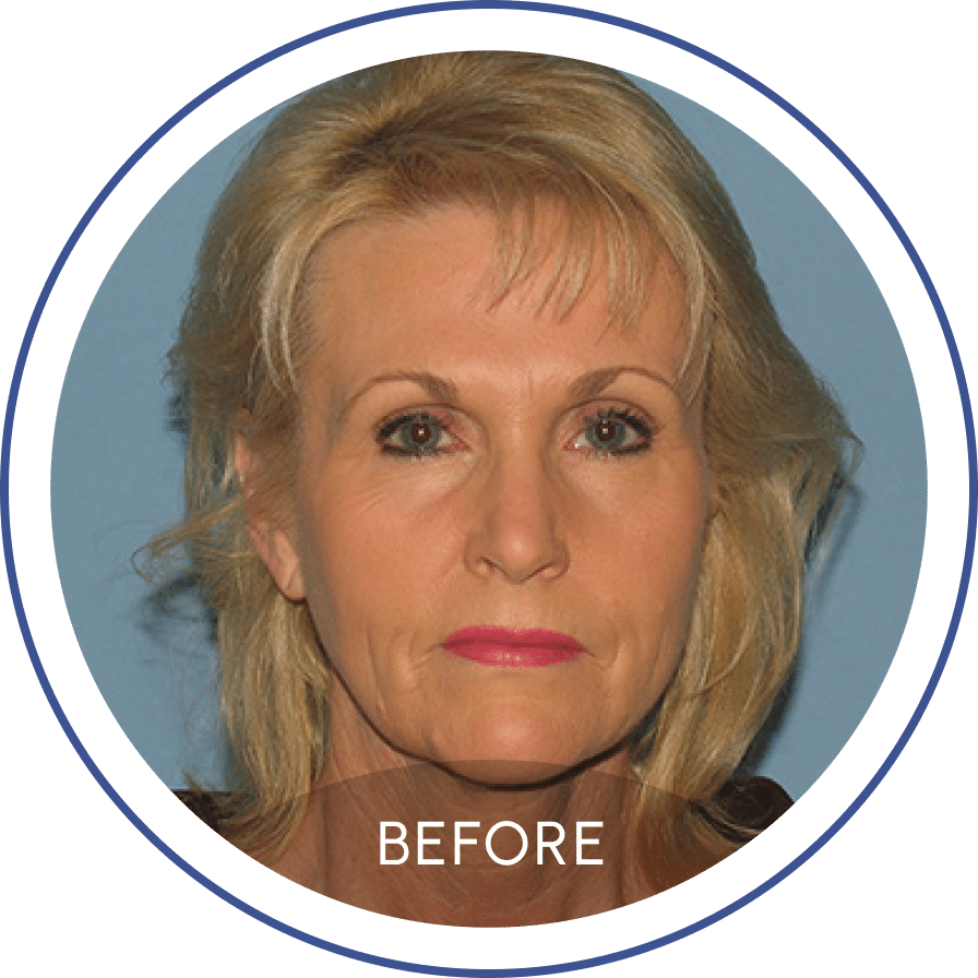 Photo of a blonde woman before facelift staring at the camera represented on Mentor Plastic Surgery and MedSpa