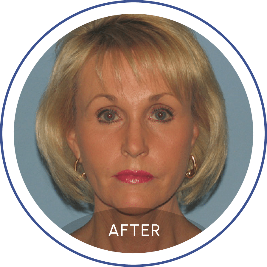 Photo of a blonde woman after facelift staring at the camera represented on Mentor Plastic Surgery and MedSpa