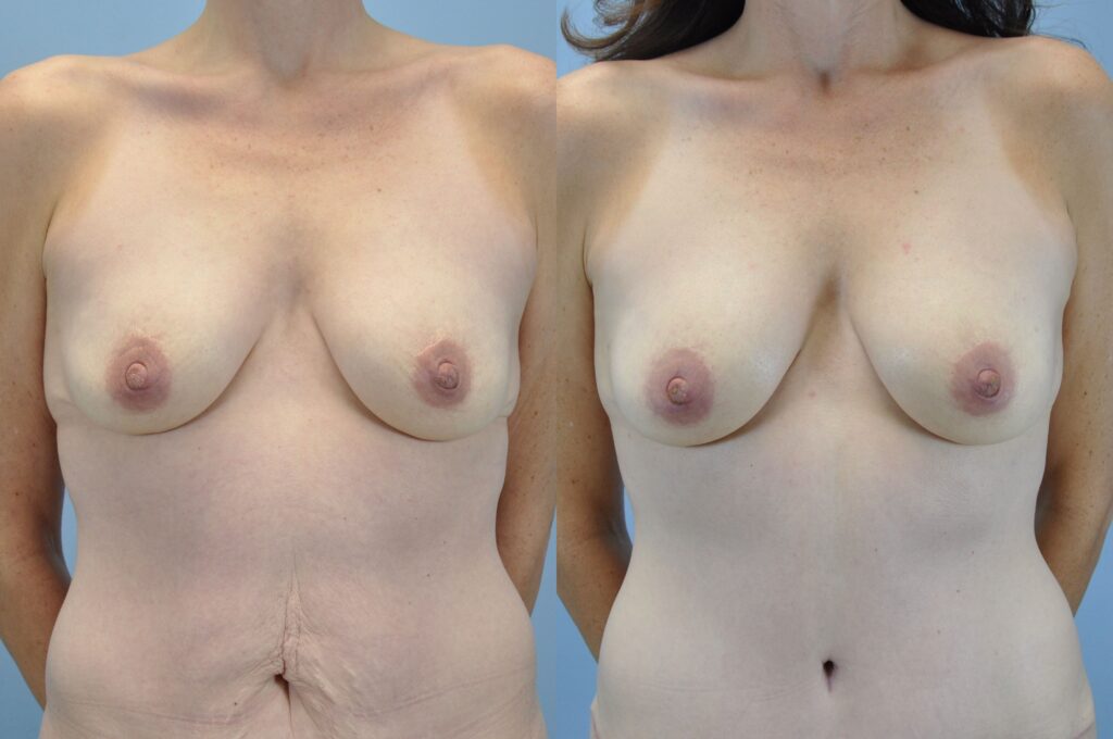 Before and after photo of a woman who received Autologous Fat Transfer treatment performed by Dr. Paul Vanek