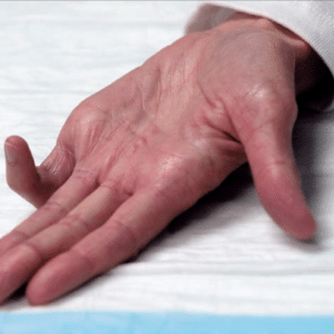 Image of a person with Dupuytren's Contracture or, "Crooked Finger" with the pinky bent upward