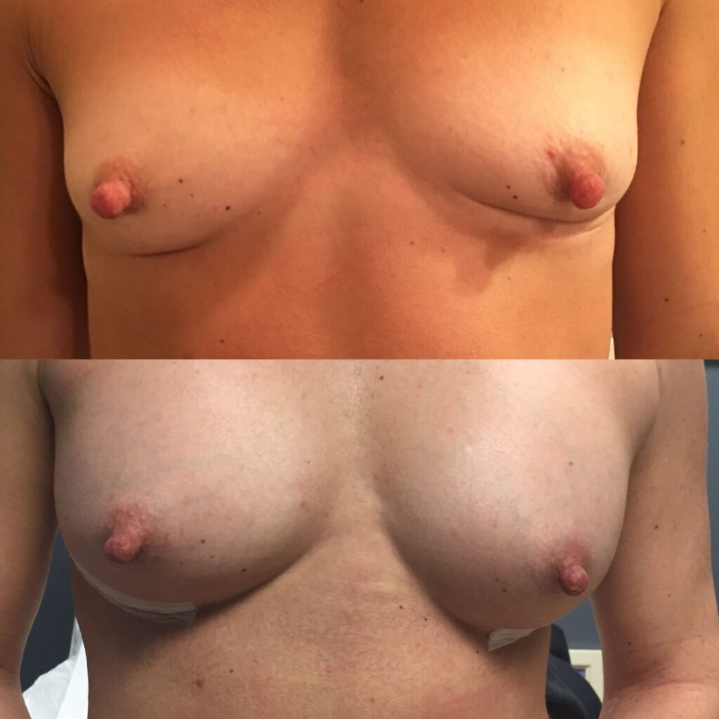 Before and after photo of a woman who received Autologous Fat Transfer treatment for breasts performed by Dr. Paul Vanek