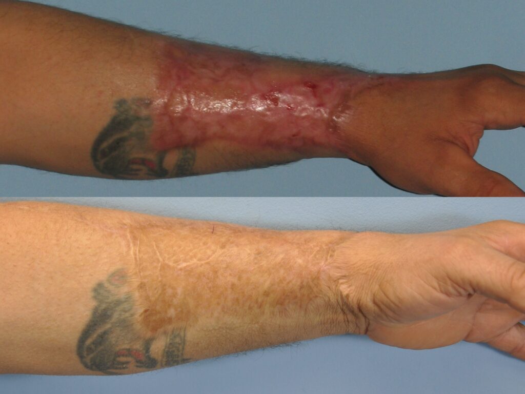 Image of a man's arm burn, before and after Autologous Fat Transfer