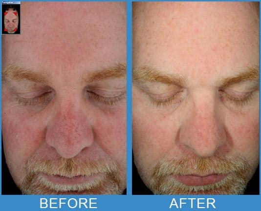 Before and after of a man who received Hydra Facial