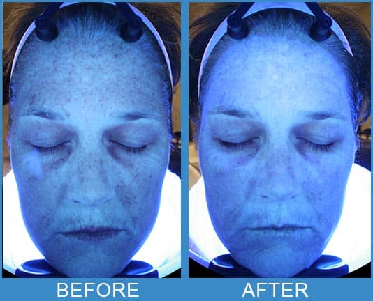 Before and after photo of a woman who received Hydra Facial, demonstrated with UV light