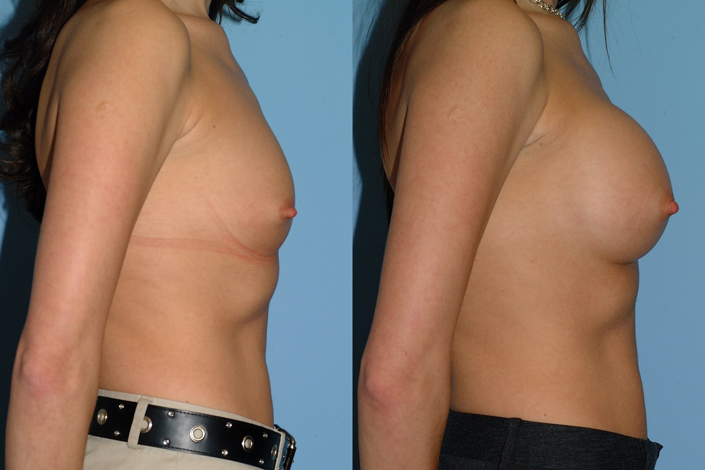Before and after patient 1 mo post op from Breast Augmentation performed by Dr. Paul Vanek