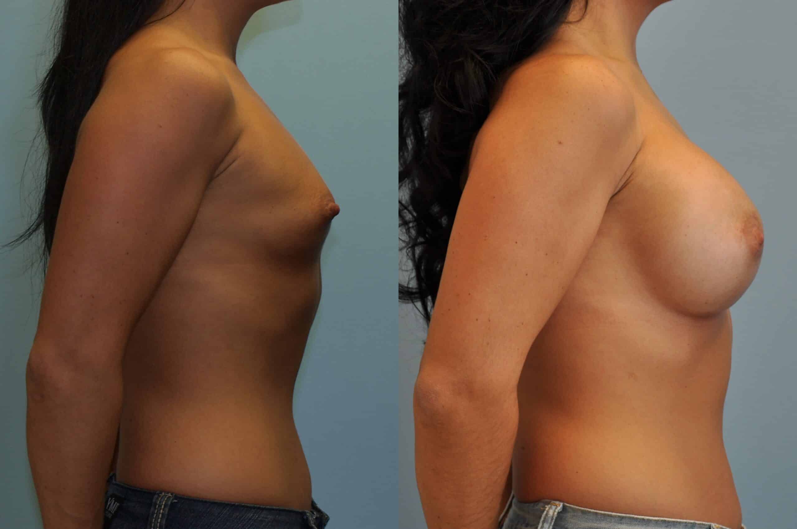 Before and after, Patient 7 mo post op from Breast Augmentation procedure performed by Dr. Paul Vanek