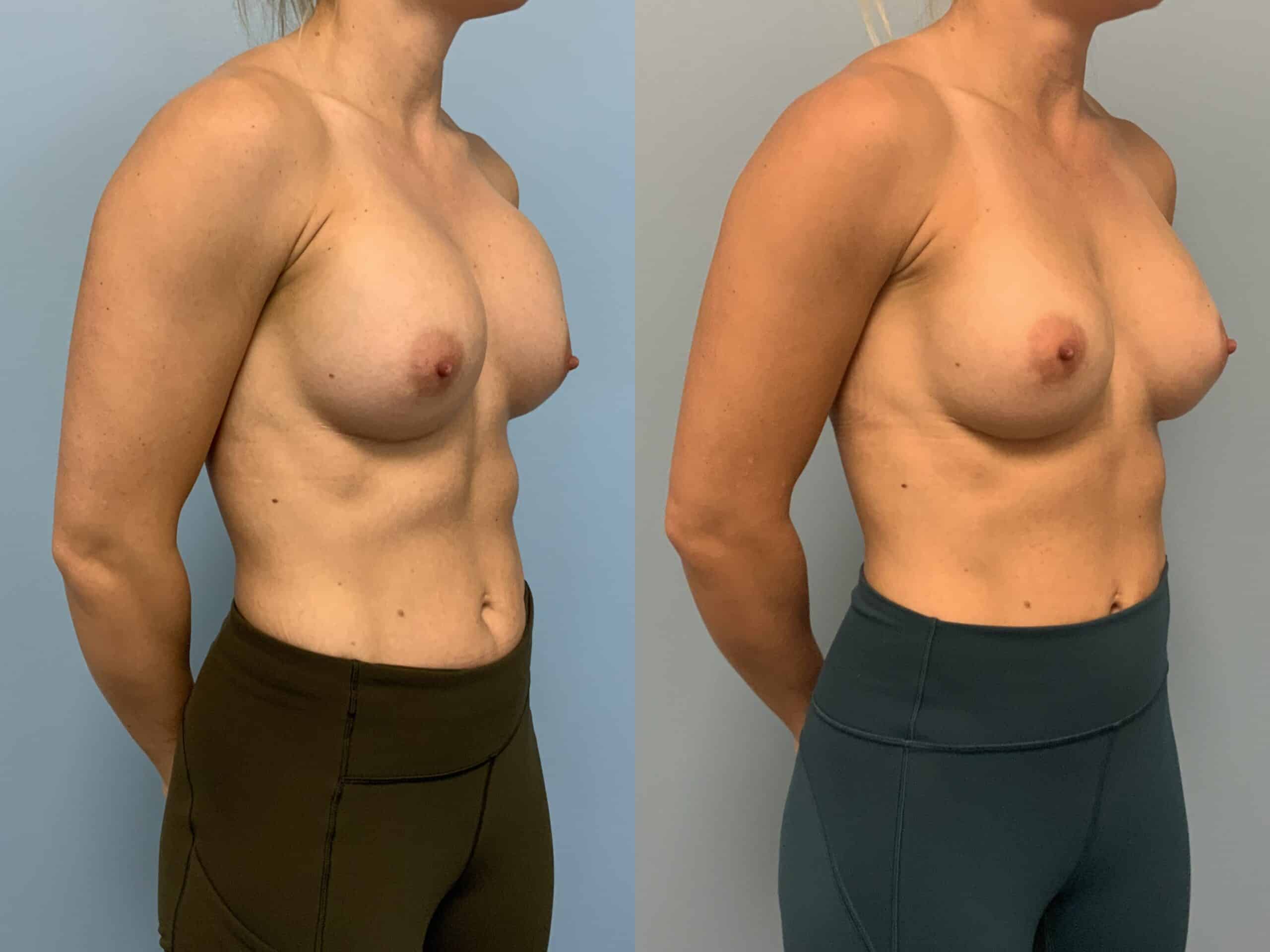 Before and after, Patient 7 mo post op from Breast Re-Augmentation, Explant of Breast Implant, Capsulectomy, Level III Muscle Release, Strattice procedures performed by Dr. Paul Vanek