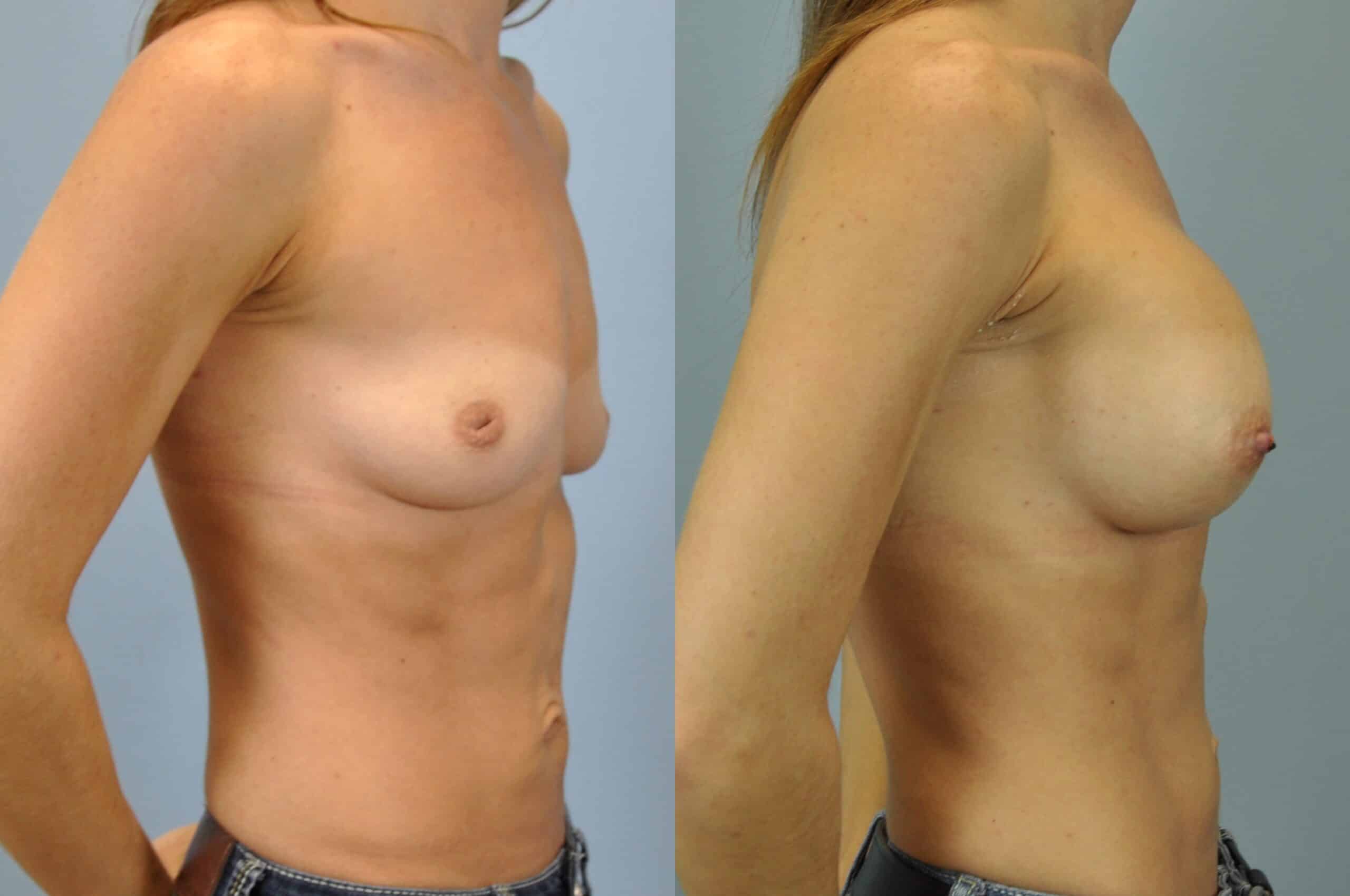 Before and after, Patient 1 mo post op from Breast Augmentation, Inverted Nipple Repair, Papuloplasty procedures performed by Dr. Paul Vanek