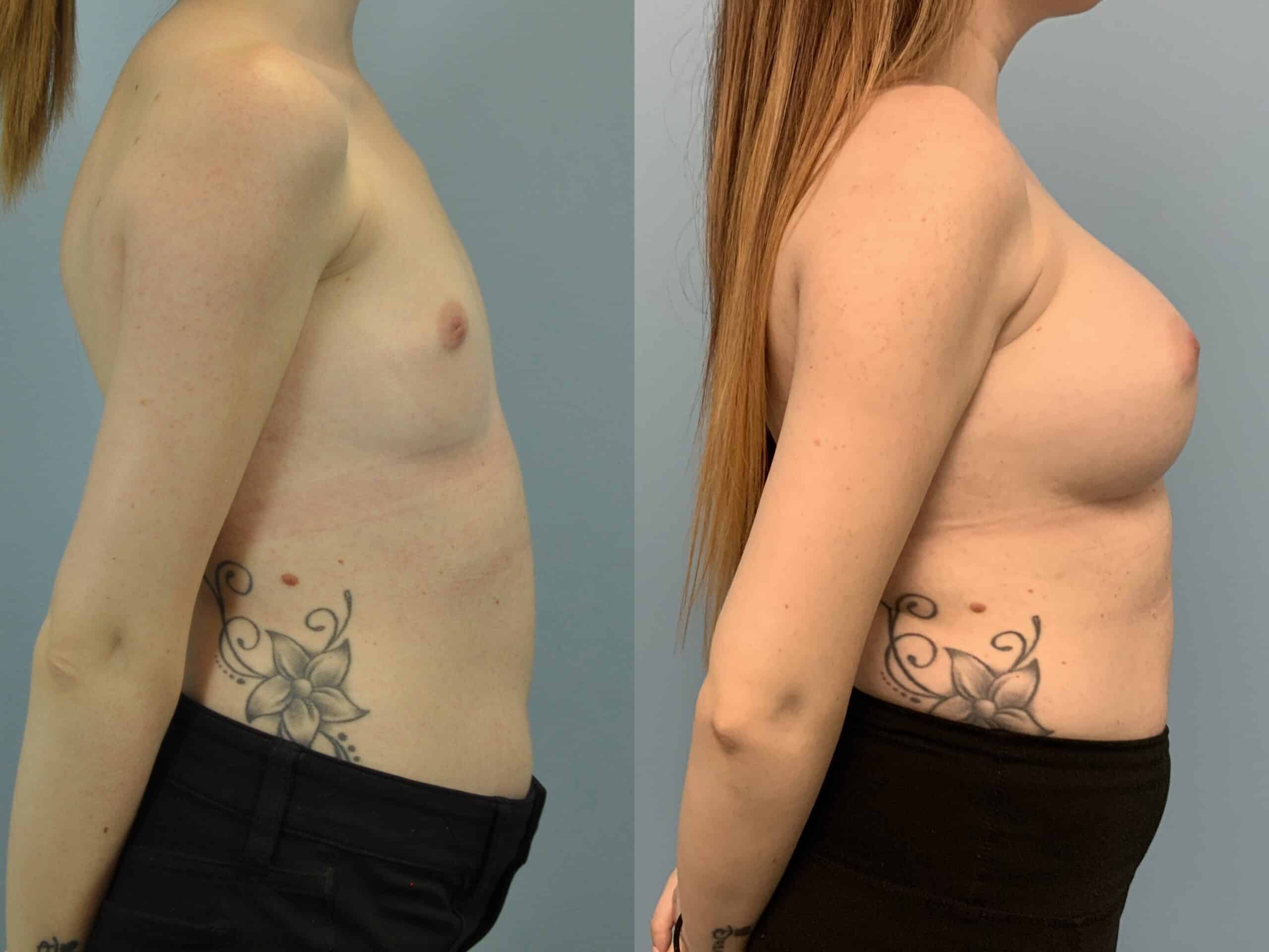 Before and after, Patient 4 yr post op from Breast Augmentation procedure performed by Dr. Paul Vanek