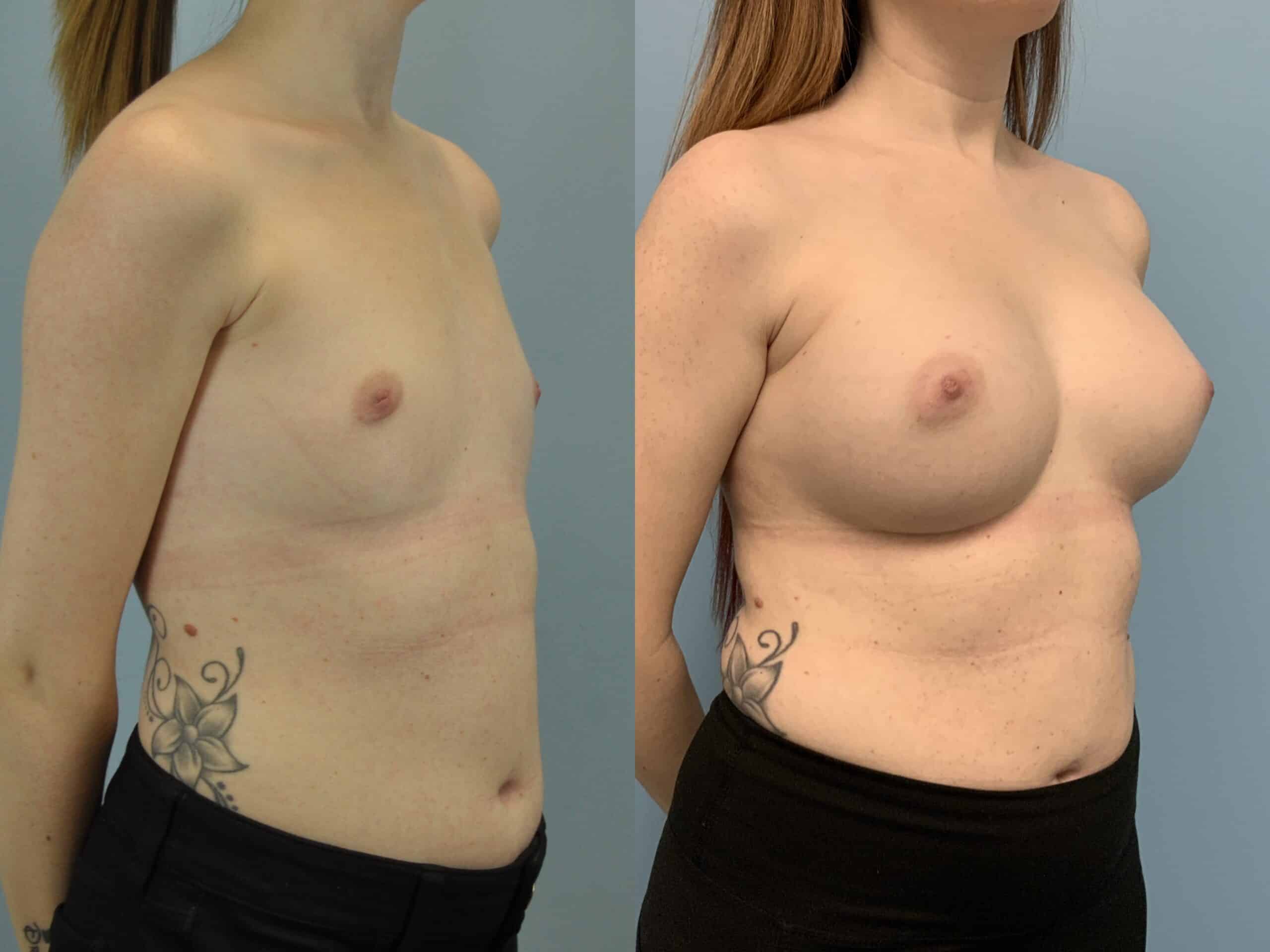 Before and after, Patient 4 yr post op from Breast Augmentation procedure performed by Dr. Paul Vanek