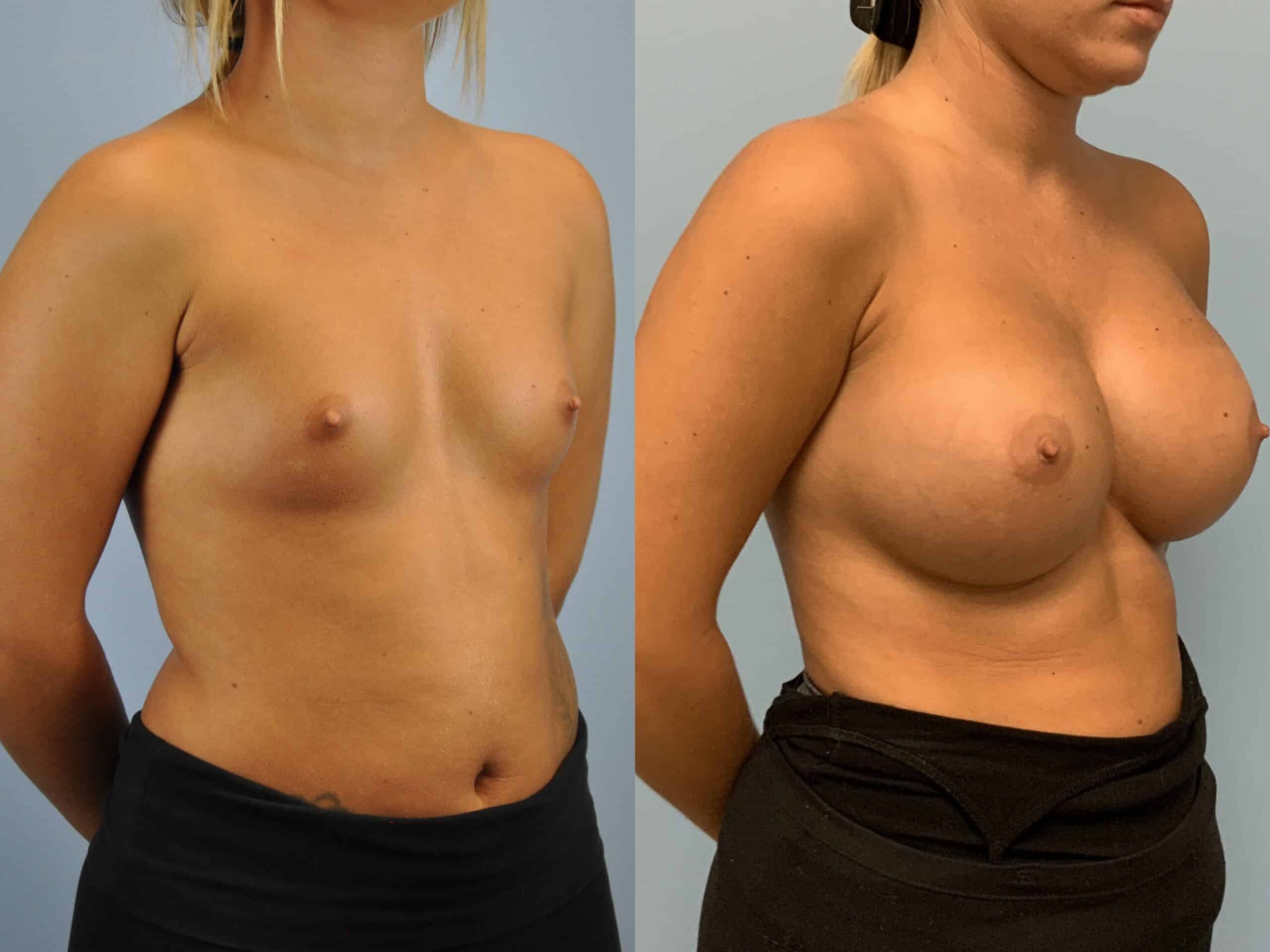 Before and after, Patient 6 mo post op from Breast Augmentation, Galaflex procedures performed by Dr. Paul Vanek