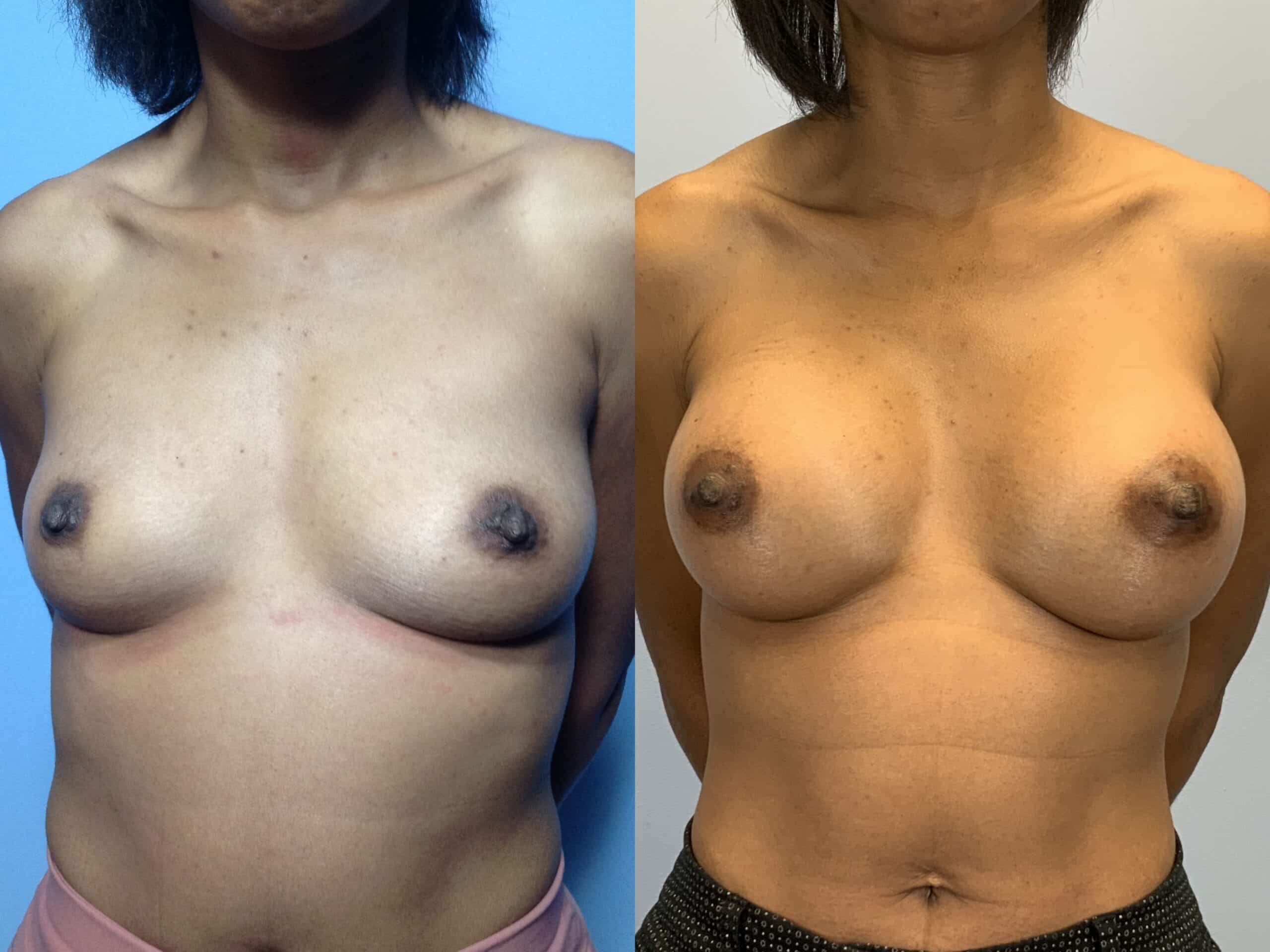 Before and after, patient 3 mo post op from Breast Augmentation and Level III Muscle Release procedures performed by Dr. Paul Vanek