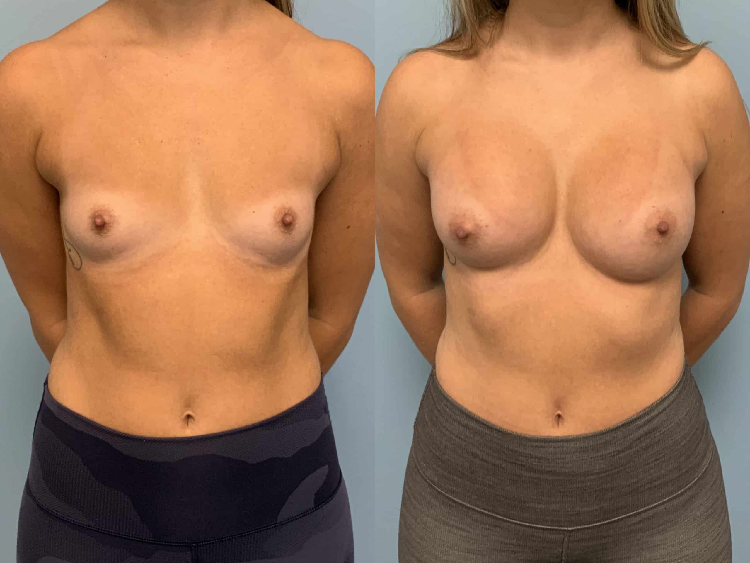Before and after, Patient 7 mo post op from Breast Augmentation, Level III Muscle Release procedures performed by Dr. Paul Vanek