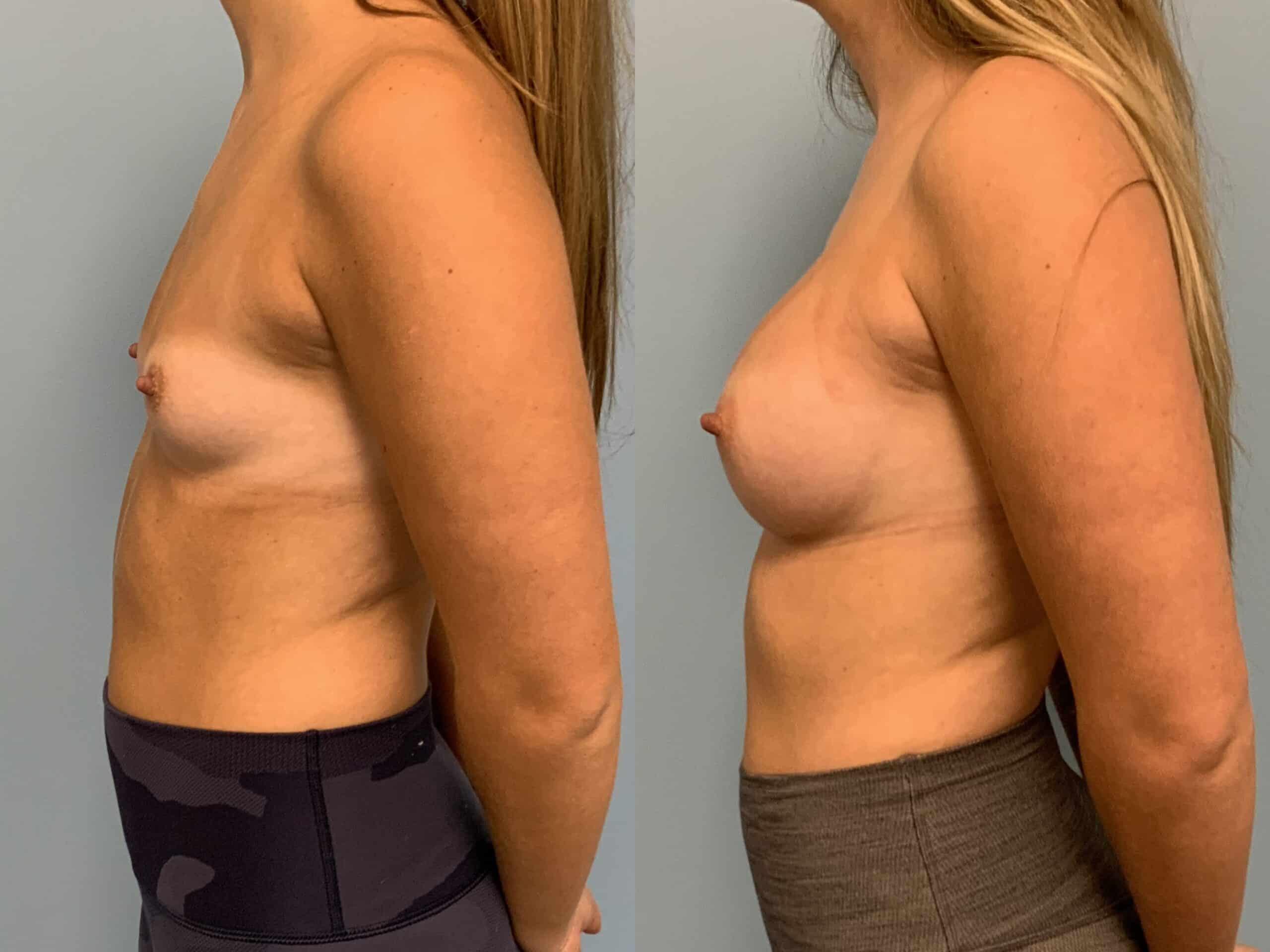 Before and after, Patient 7 mo post op from Breast Augmentation, Level III Muscle Release procedures performed by Dr. Paul Vanek