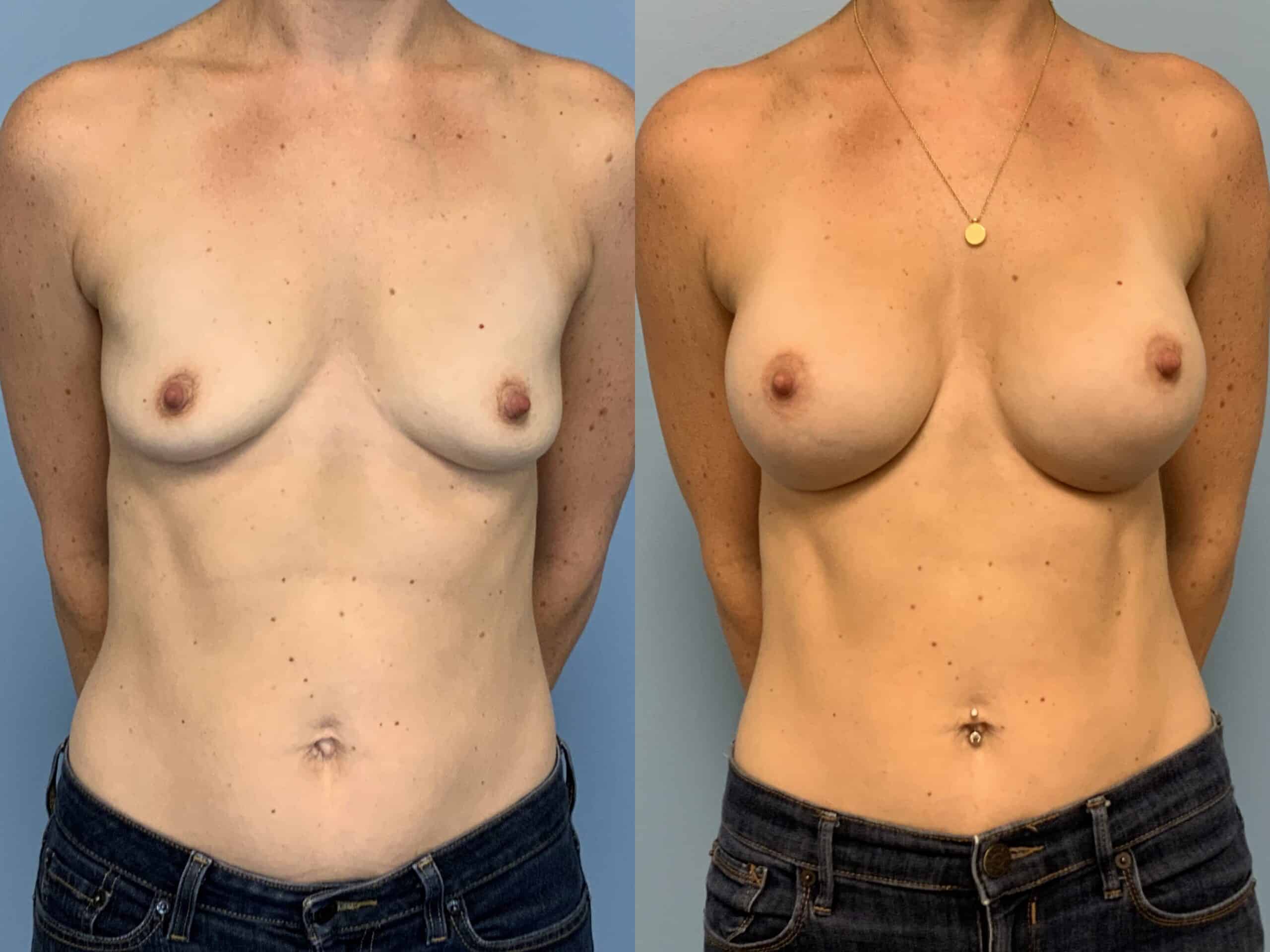 Before and after patient 10 mo post op from Breast Augmentation, Level III Muscle Release performed by Dr. Paul Vanek