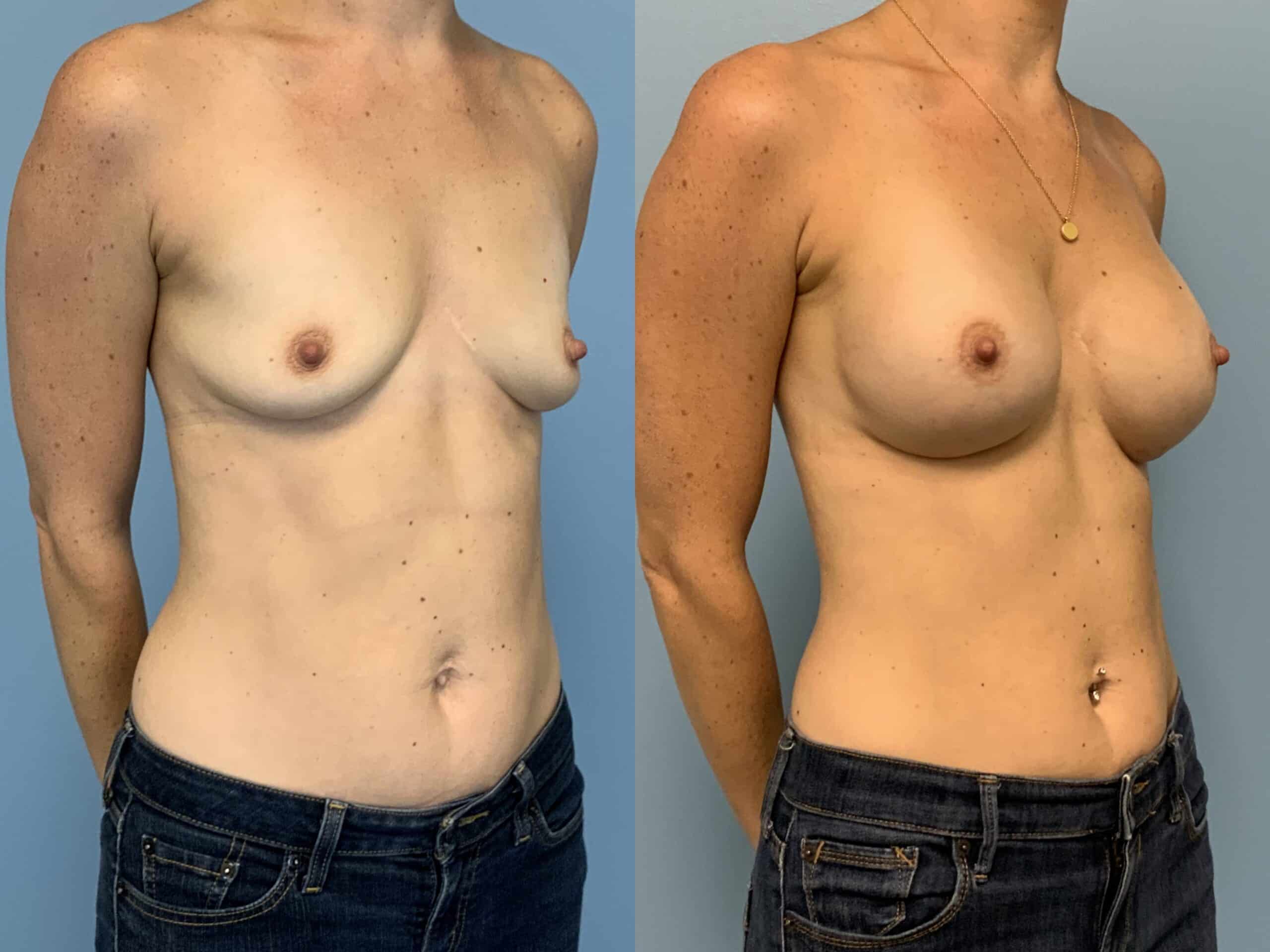 Before and after patient 10 mo post op from Breast Augmentation, Level III Muscle Release performed by Dr. Paul Vanek