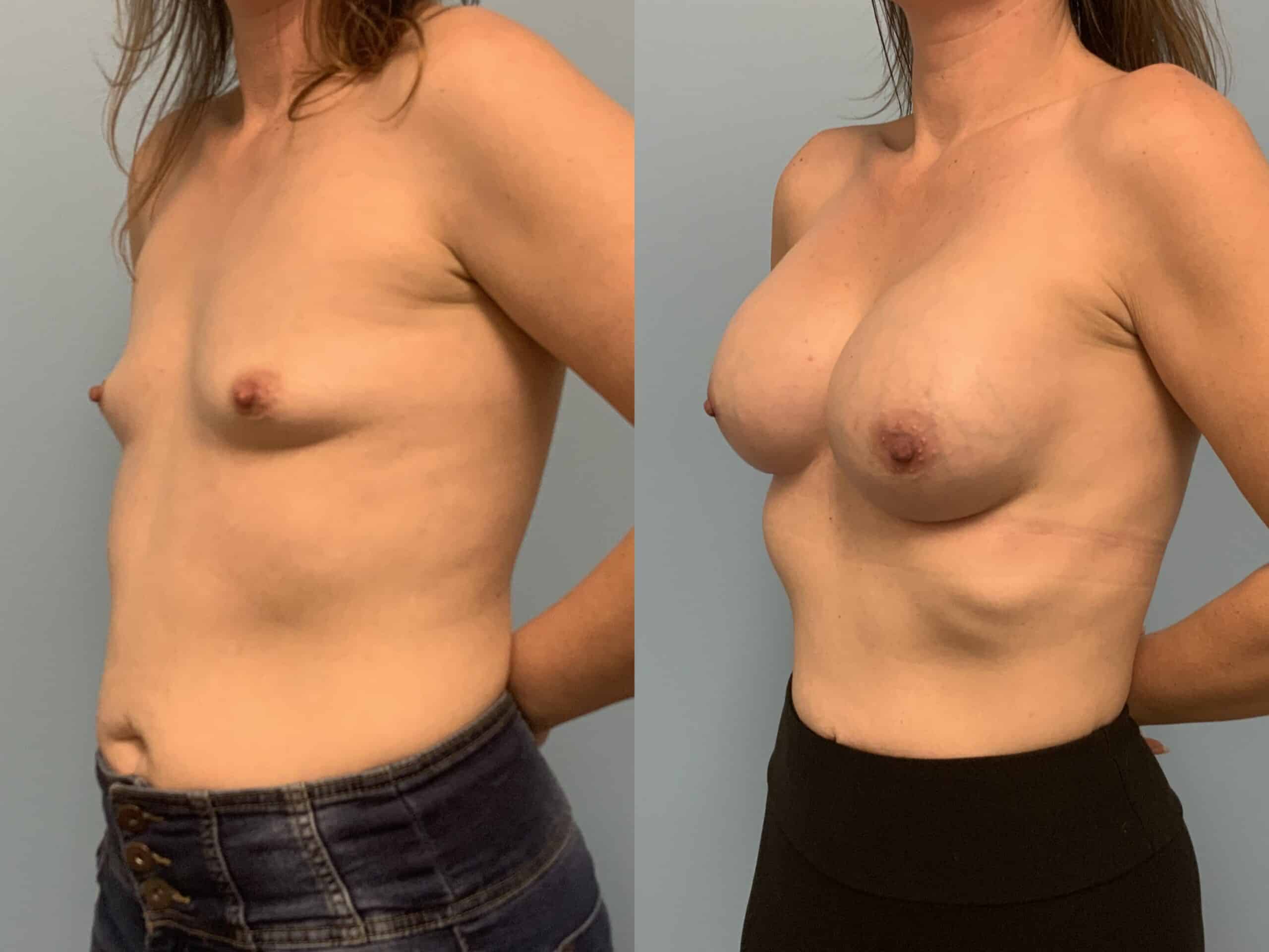 Before and after, patient 3 mo post op from Breast Augmentation and Level III Muscle Release procedure performed by Dr. Paul Vanek