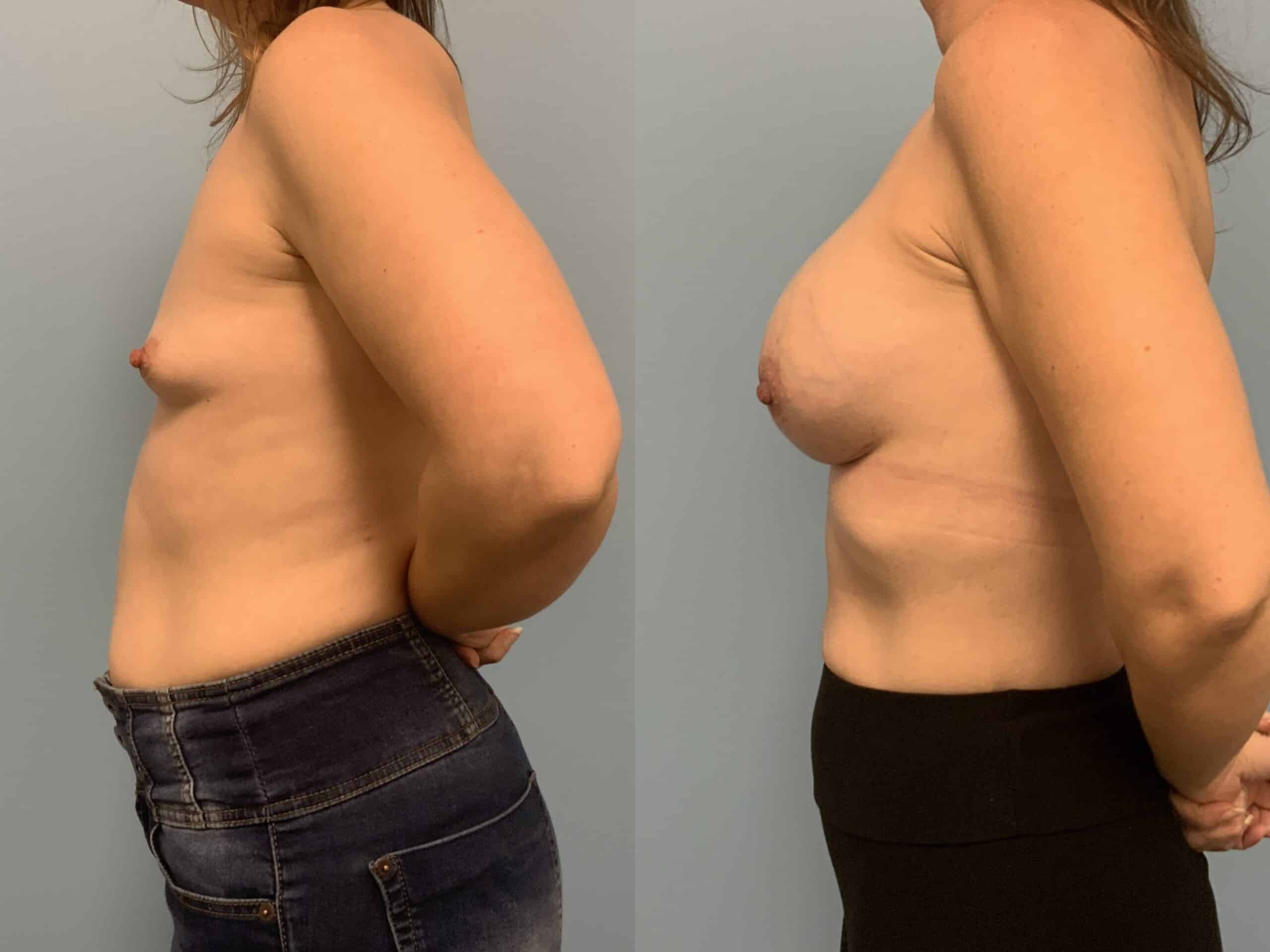Before and after, patient 3 mo post op from Breast Augmentation and Level III Muscle Release procedure performed by Dr. Paul Vanek
