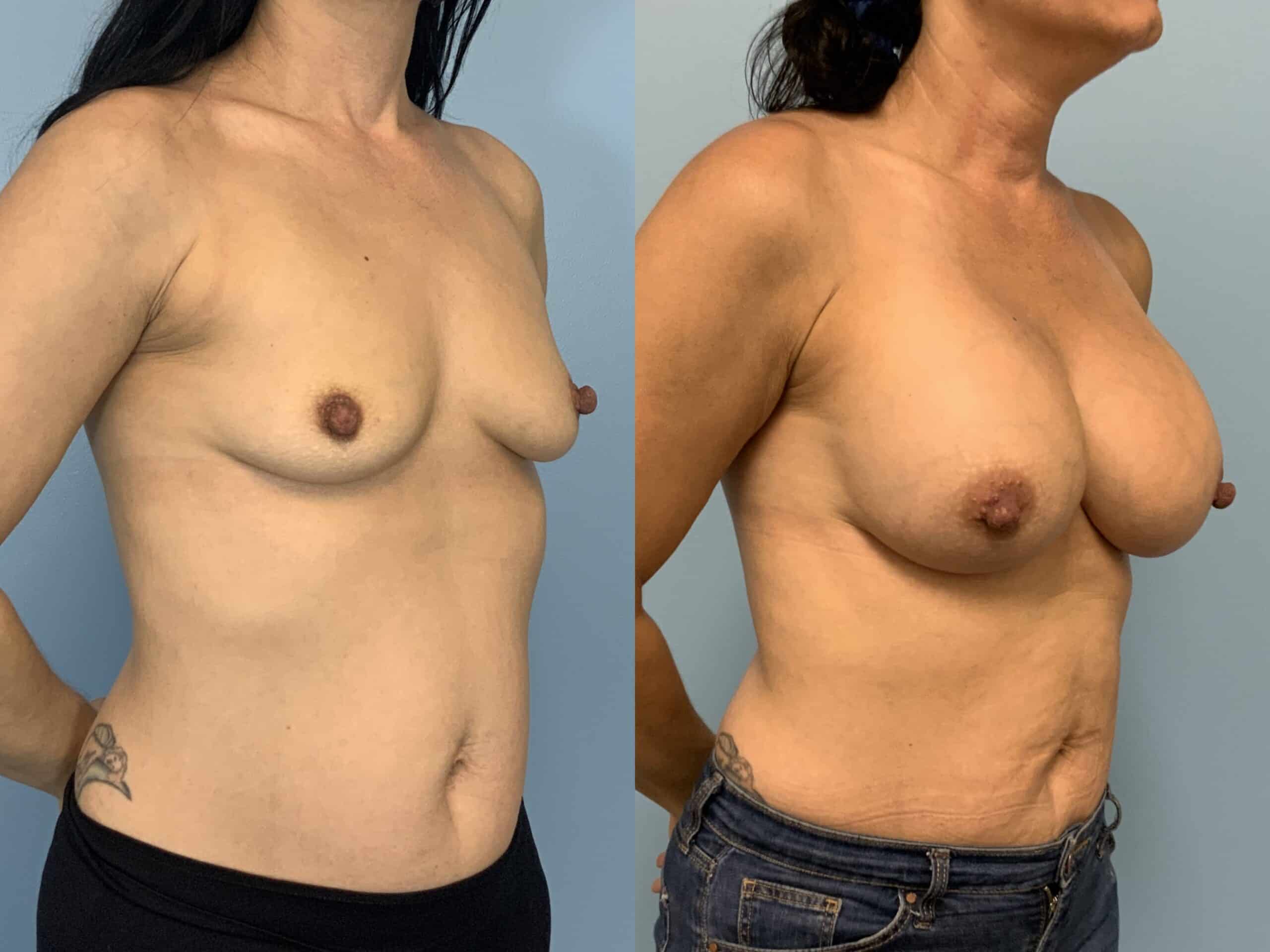 Before and after, Patient 2 mo post op from Breast Augmentation, Level III Muscle Release, Galaflex Reinforcement procedures performed by Dr. Paul Vanek