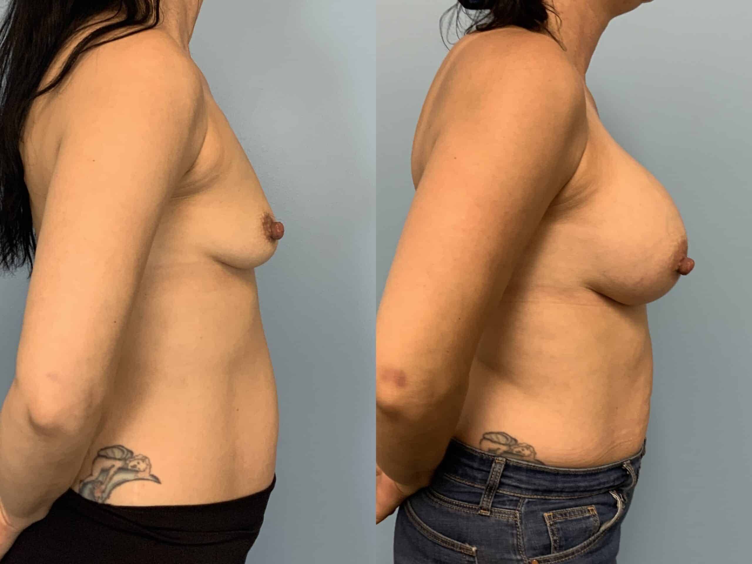 Before and after, Patient 2 mo post op from Breast Augmentation, Level III Muscle Release, Galaflex Reinforcement procedures performed by Dr. Paul Vanek