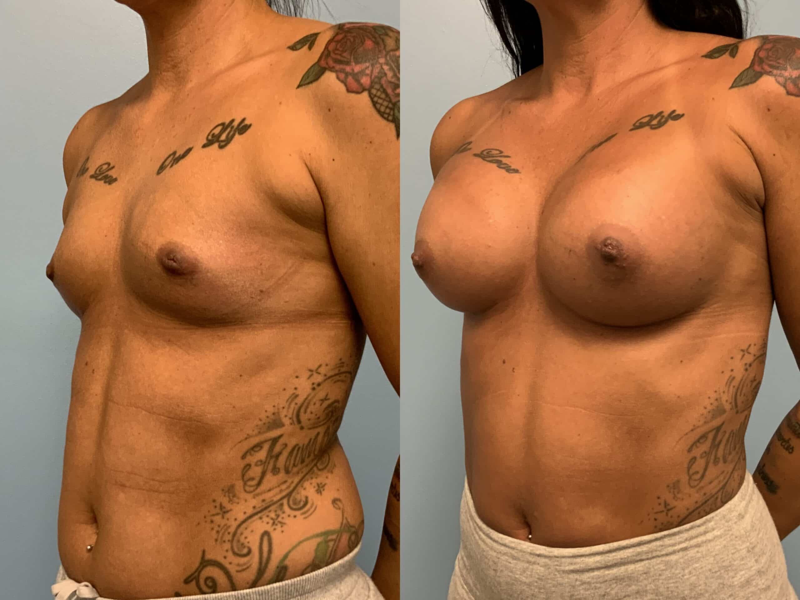 Patient before and after, 2 mo post op from Breast Augmentation and Level III Muscle Release procedures performed by Dr. Paul Vanek