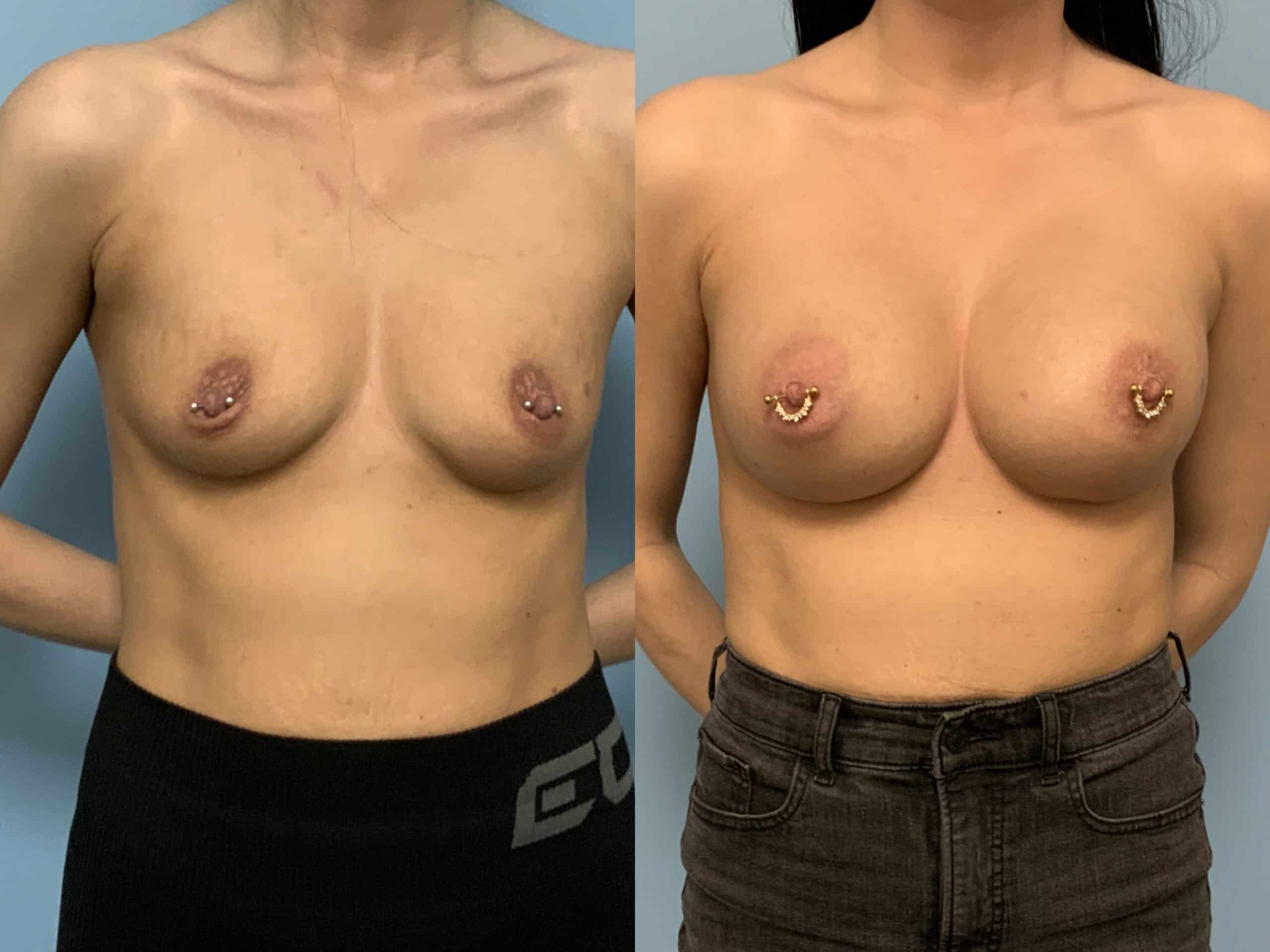Before and after of patient 6 mo post op from Breast Augmentation, Level III Muscle Release performed by Dr. Paul Vanek