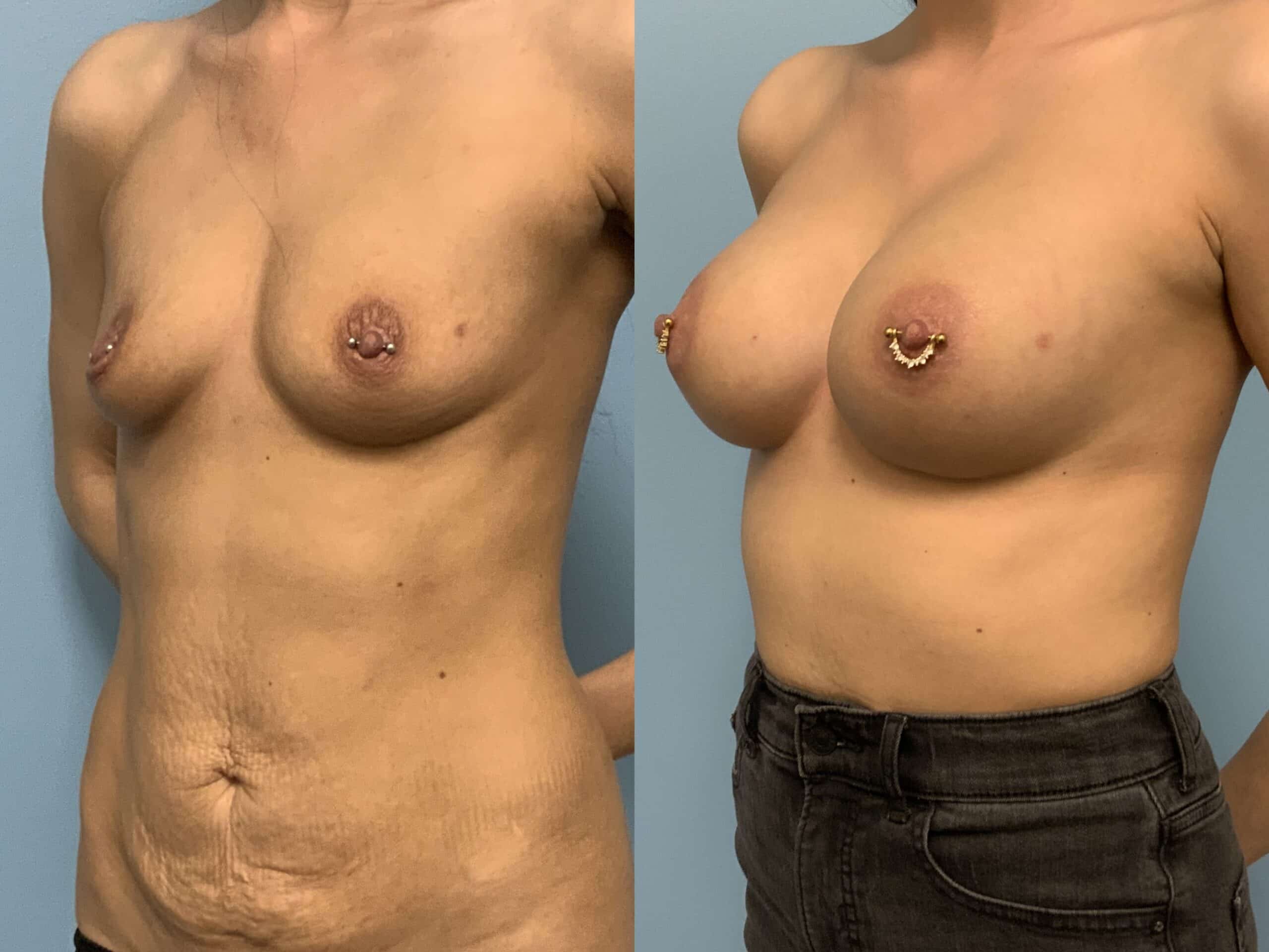Before and after of patient 6 mo post op from Breast Augmentation, Level III Muscle Release performed by Dr. Paul Vanek