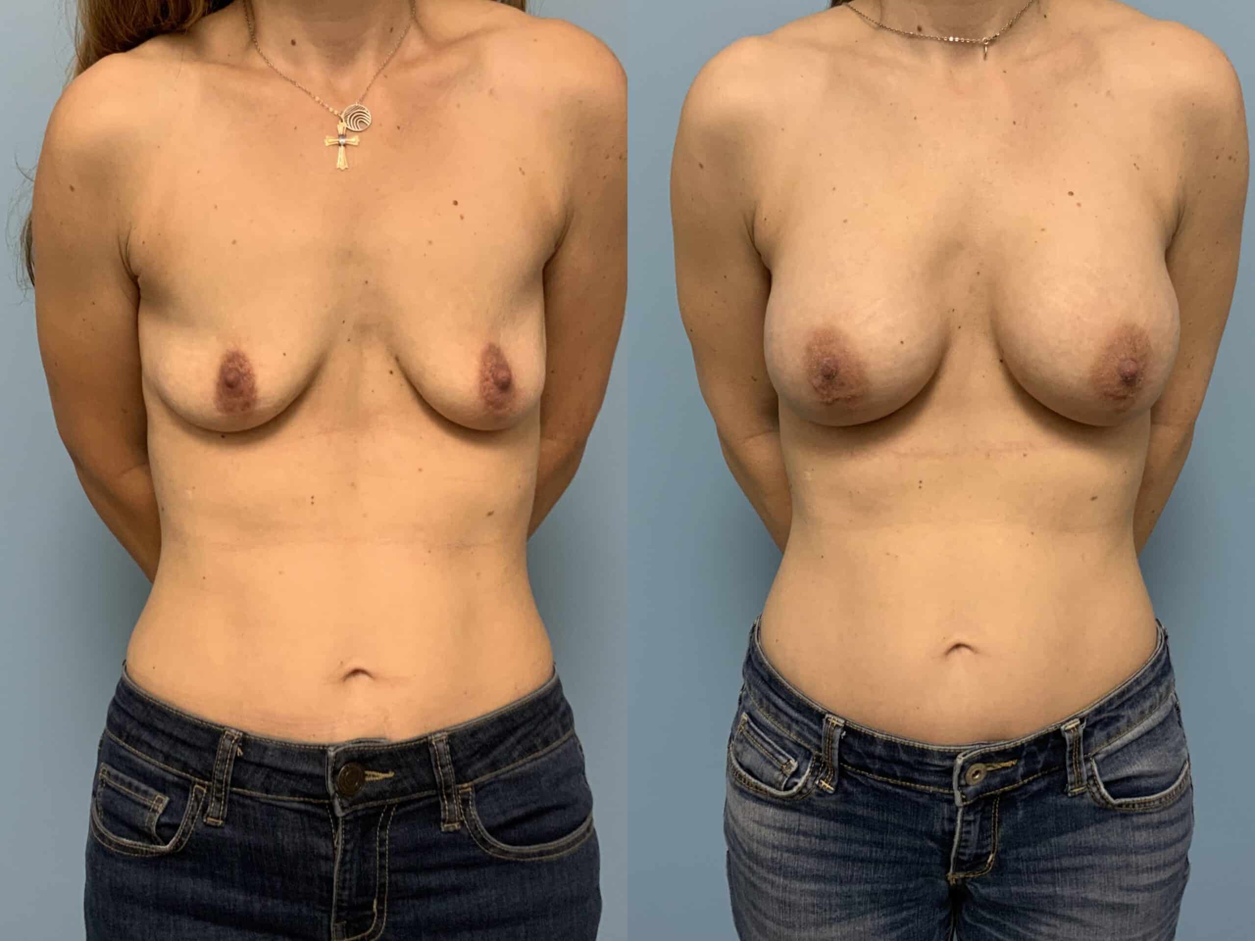Before and after, patient 5 mo post op from Breast augmentation and level III muscle release procedures performed by Dr. Paul Vanek