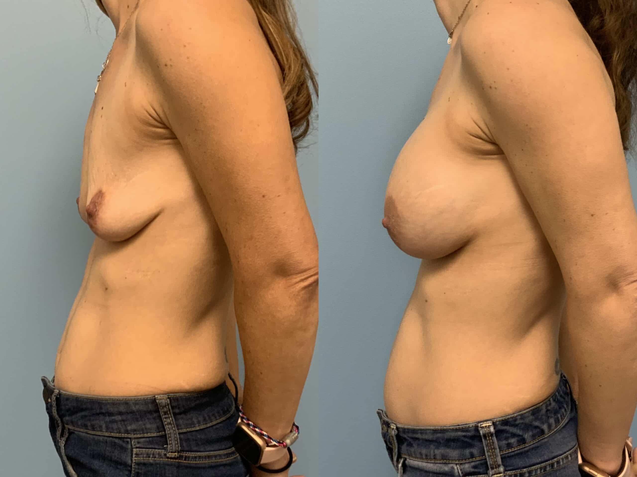 Before and after, patient 5 mo post op from Breast augmentation and level III muscle release procedures performed by Dr. Paul Vanek