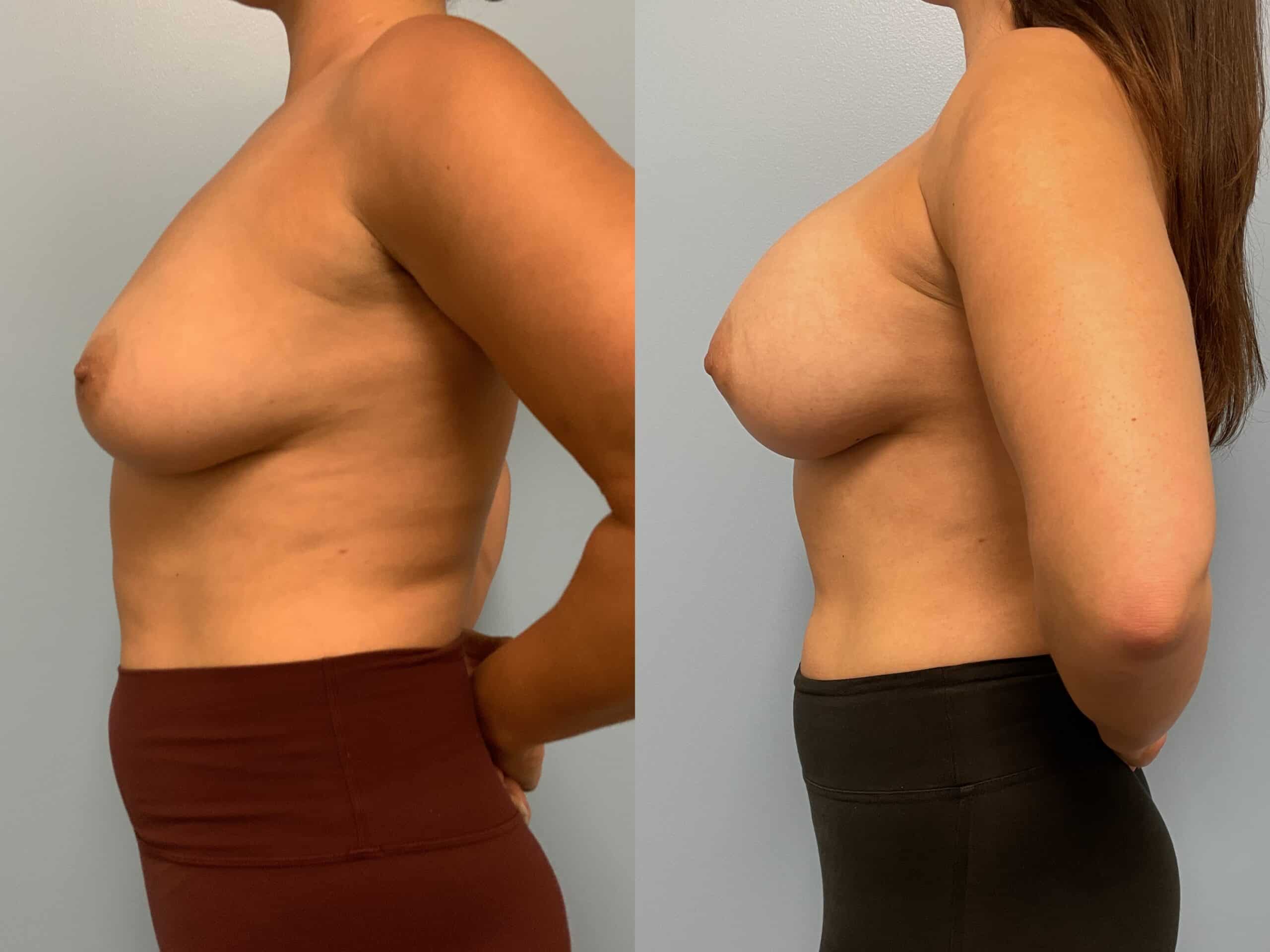 Before and after, patient 2 mo post op from Breast Augmentation, Level III Muscle Release, Strattice Inlay procedures performed by Dr. Paul Vanek