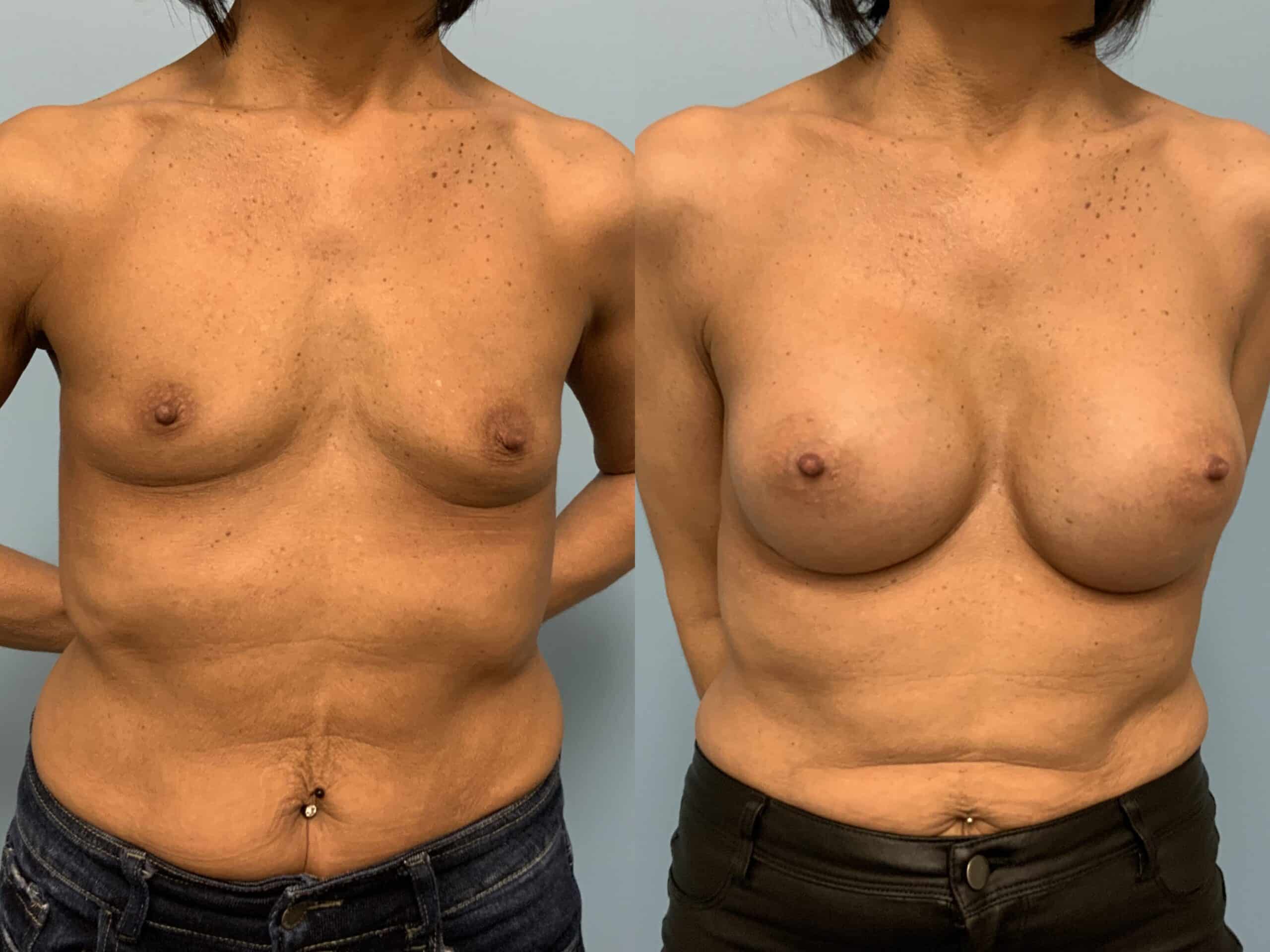 Before and after, Patient 2 mo post op from Breast augmentation, Level III Muscle Release procedure performed by Dr. Paul Vanek