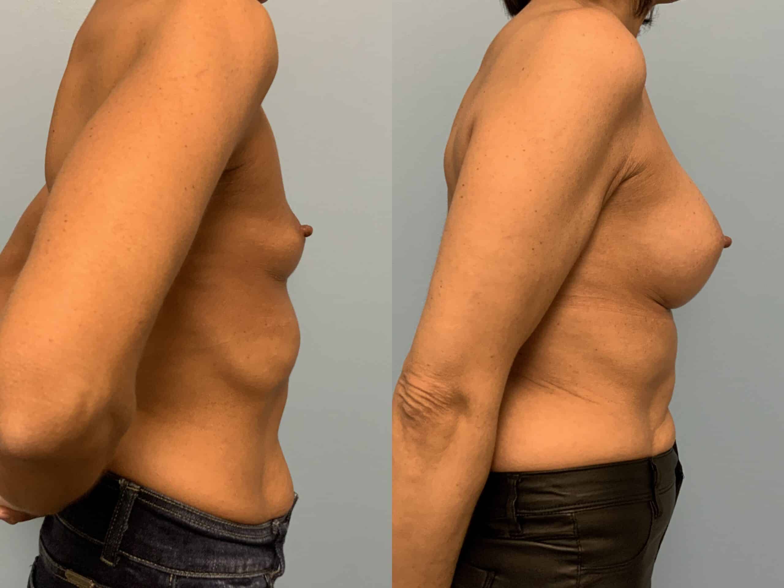 Before and after, Patient 2 mo post op from Breast augmentation, Level III Muscle Release procedure performed by Dr. Paul Vanek