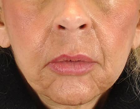 Patient 1 mo post op from Mentor Peel and Lip Augmentation procedure performed by Dr. Paul Vanek